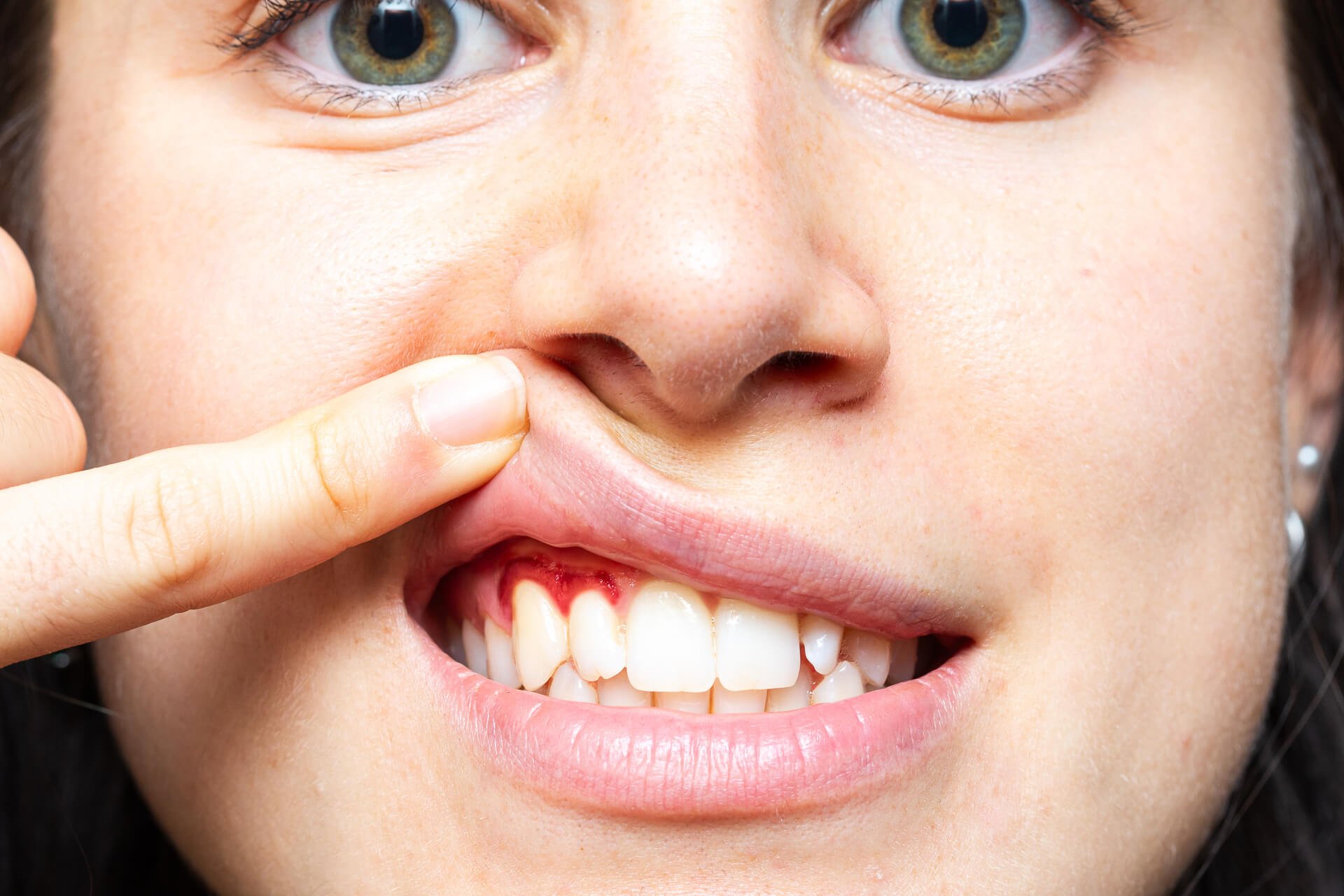 How to stop bleeding gums