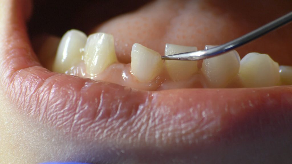 loose tooth in adults