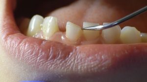 loose tooth in adults