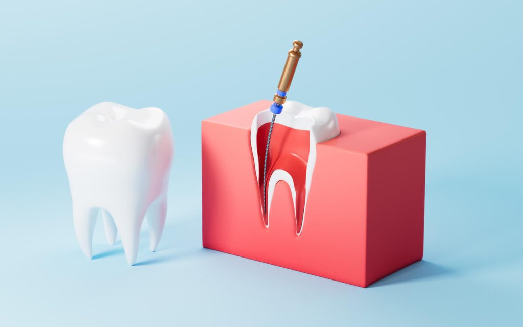 Root Canal or Dental Filling