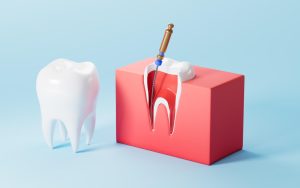 Root Canal or Dental Filling